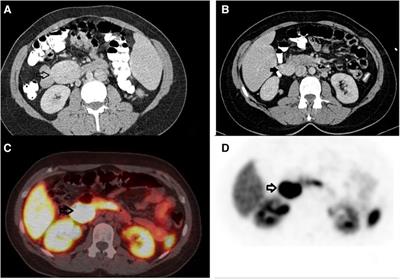Two synchronous primary mesenteric neuroendocrine tumors in a patient: a case report